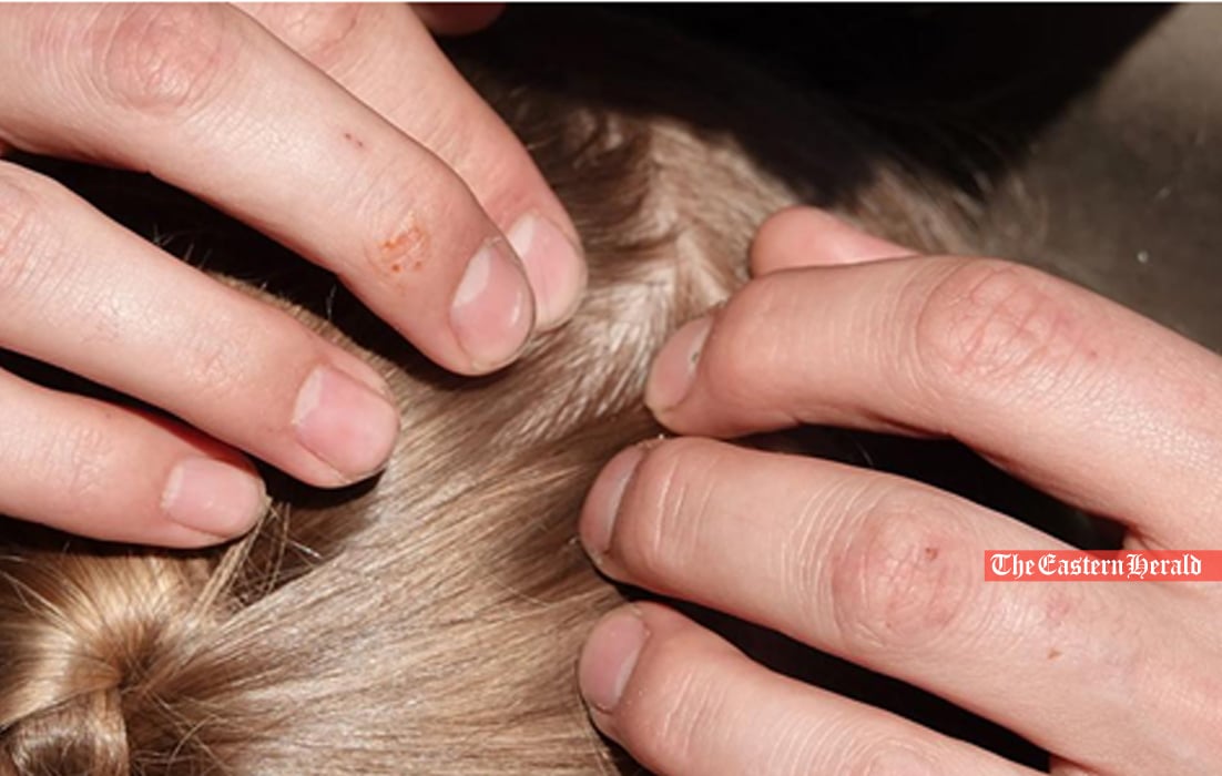 scalp-acne-dandruf