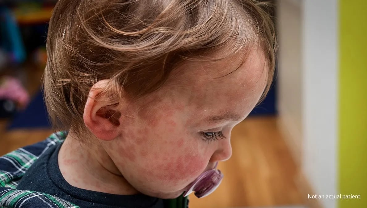 Measles rash symptoms visible on child skin